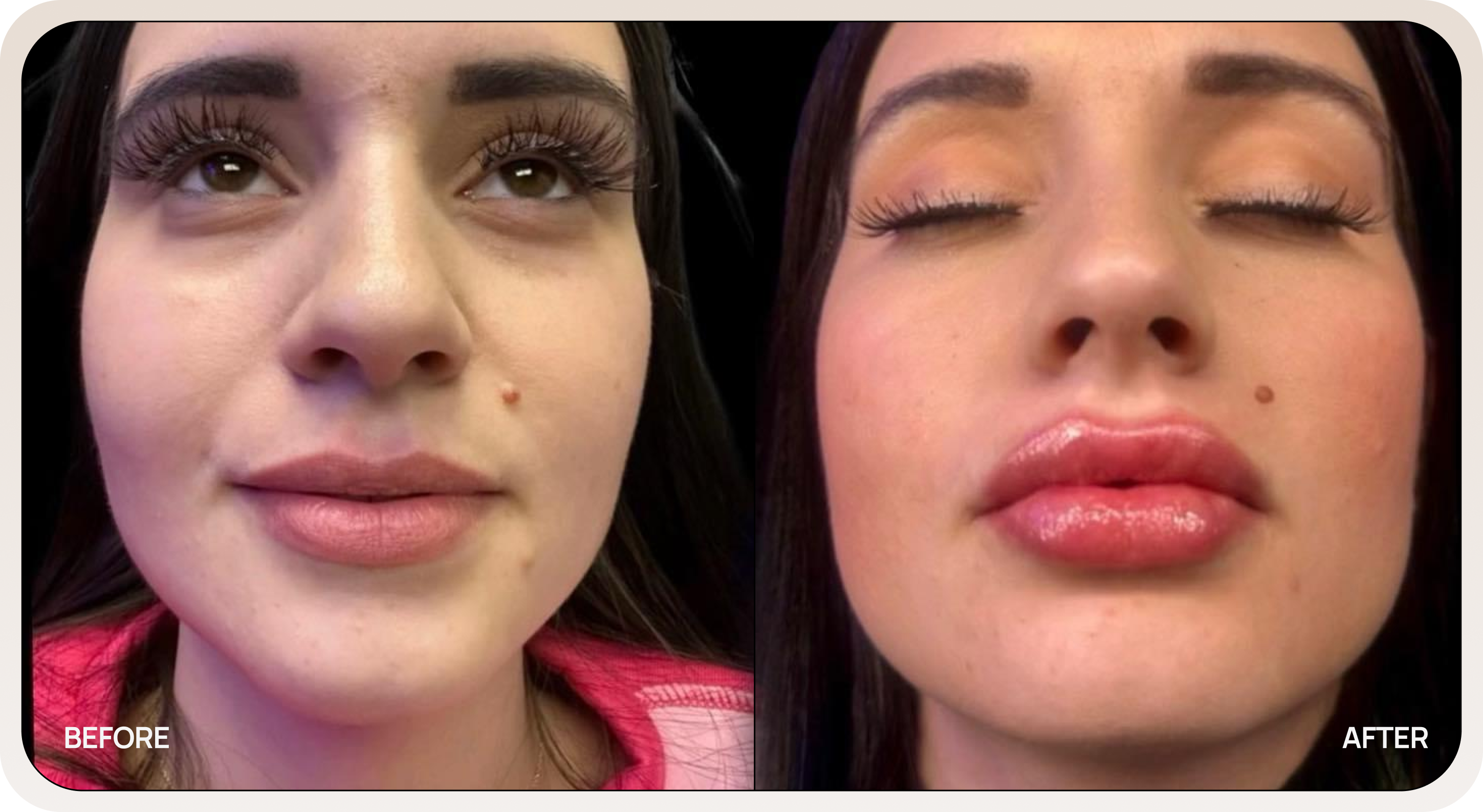 Lip fillers before and after