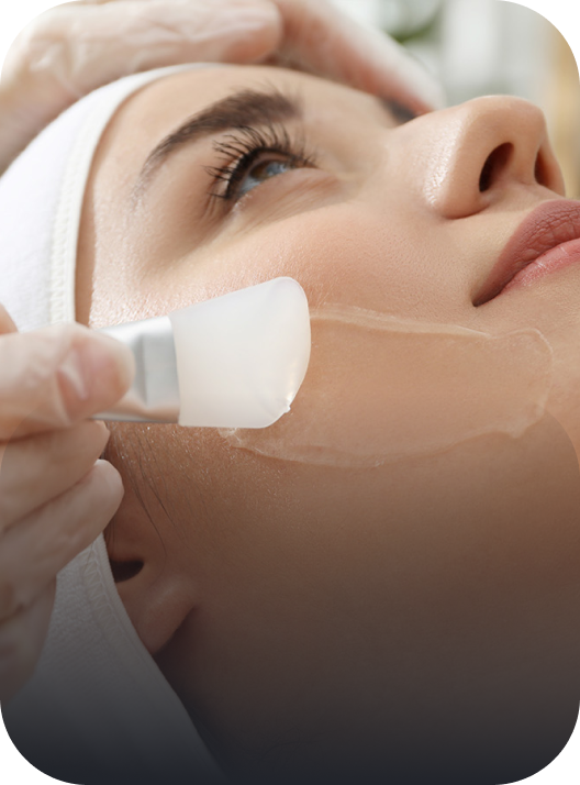 Chemical Peels